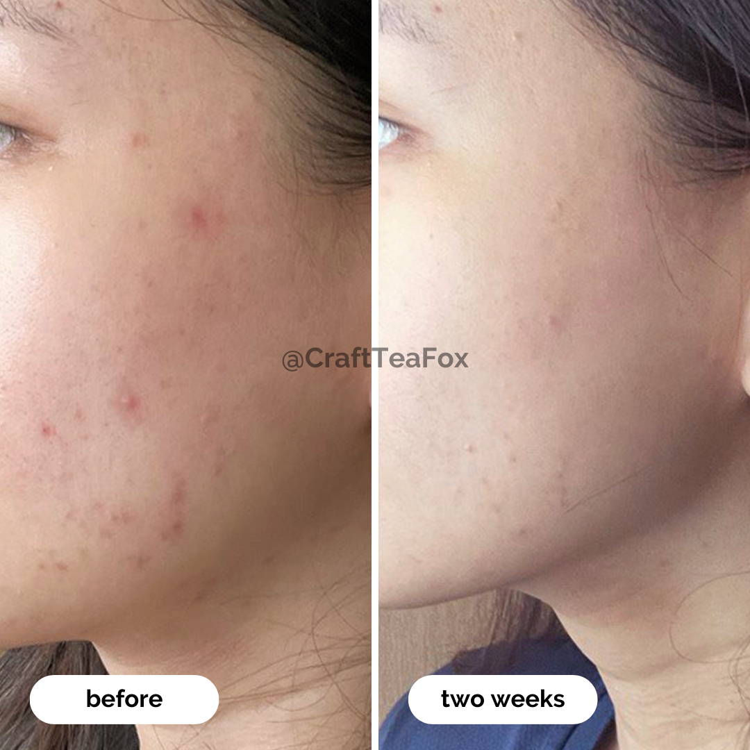 How Matcha Combats Acne Crafti